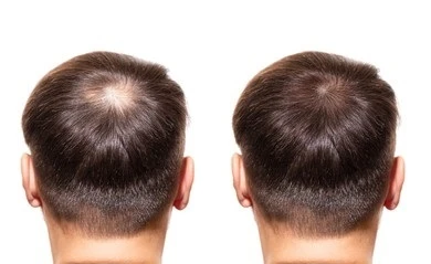 Unlock the Secrets to Mastering Your Hair Transplant Experience in Dubai