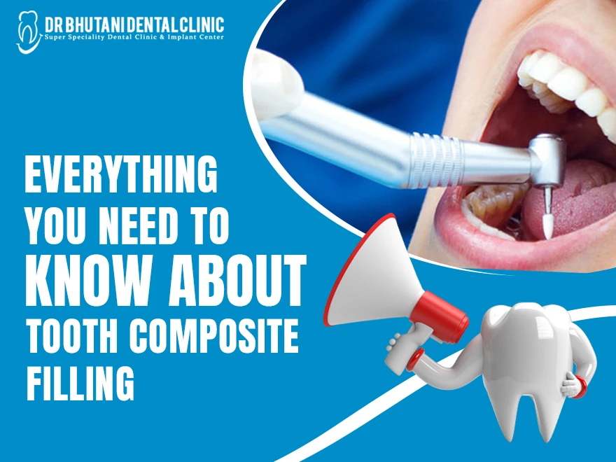 Everything You Need To Know About Tooth Composite Filling