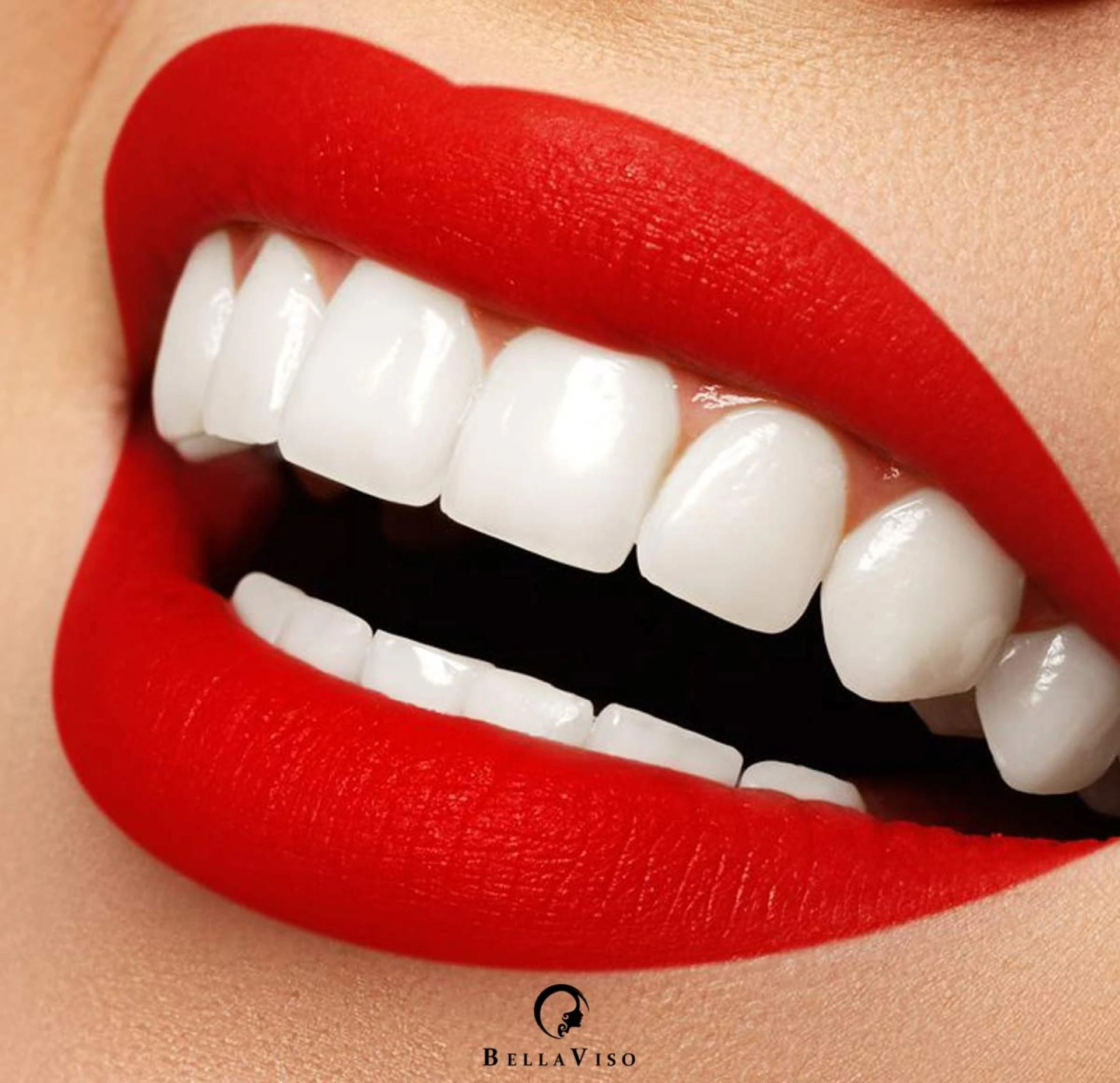 Transforming Smiles Affordably: The Secret to Affordable Dental Veneers Treatment in Dubai