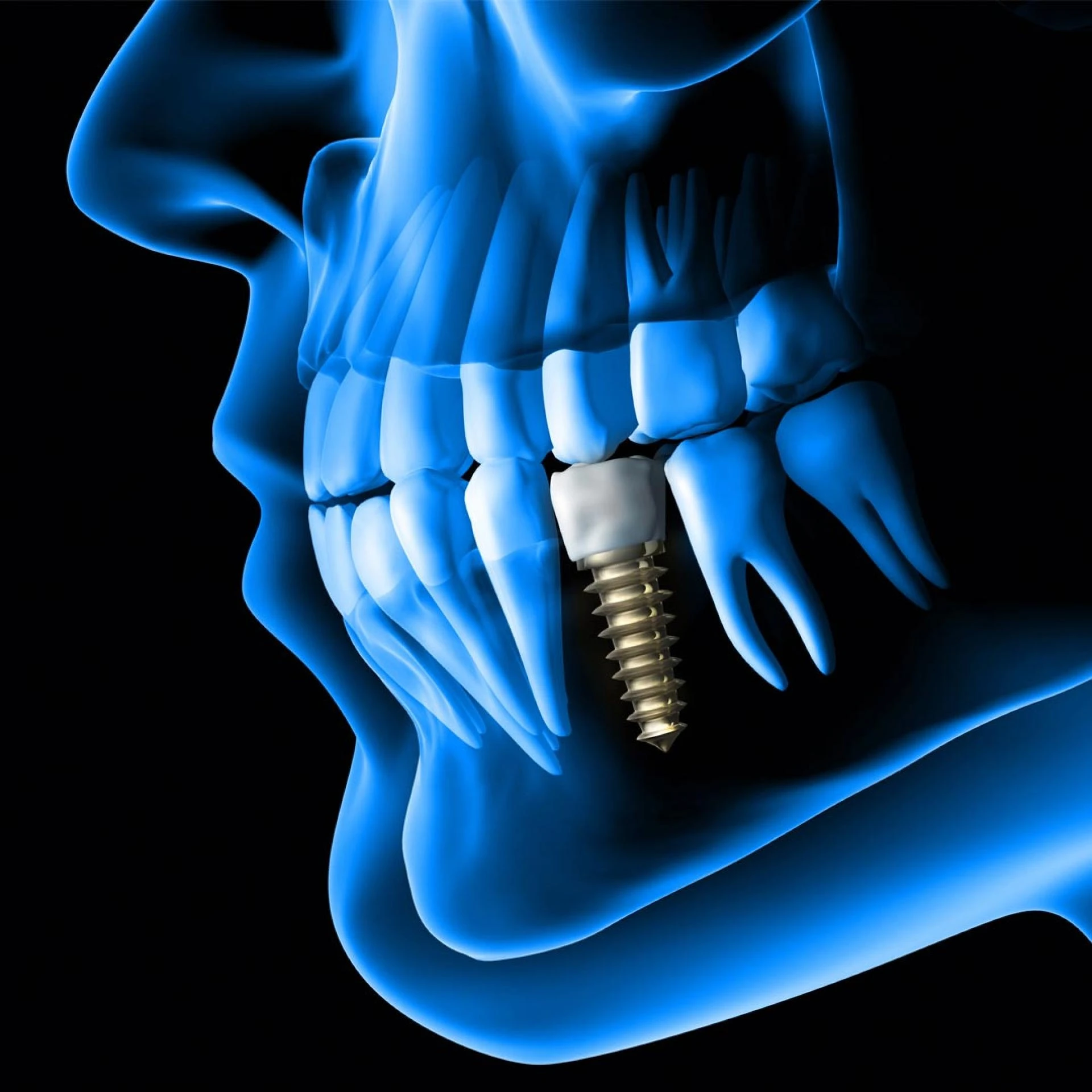 Elevate Your Smile: Unveiling the Best Dental Implants in Dubai