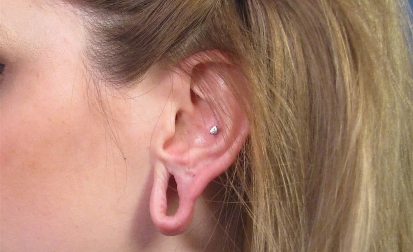 Earlobe Repair: How to Fix Stretched Out Earring Holes