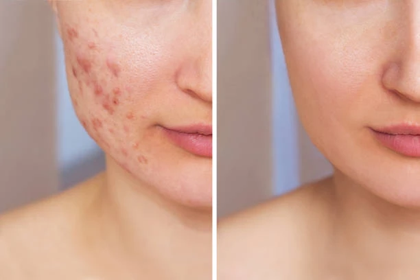 Pigmentation &amp; Acne Troubles? Flawless Skin is a Treatment Away!