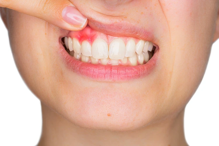 Top signs of tooth decay &amp; common Dental Health