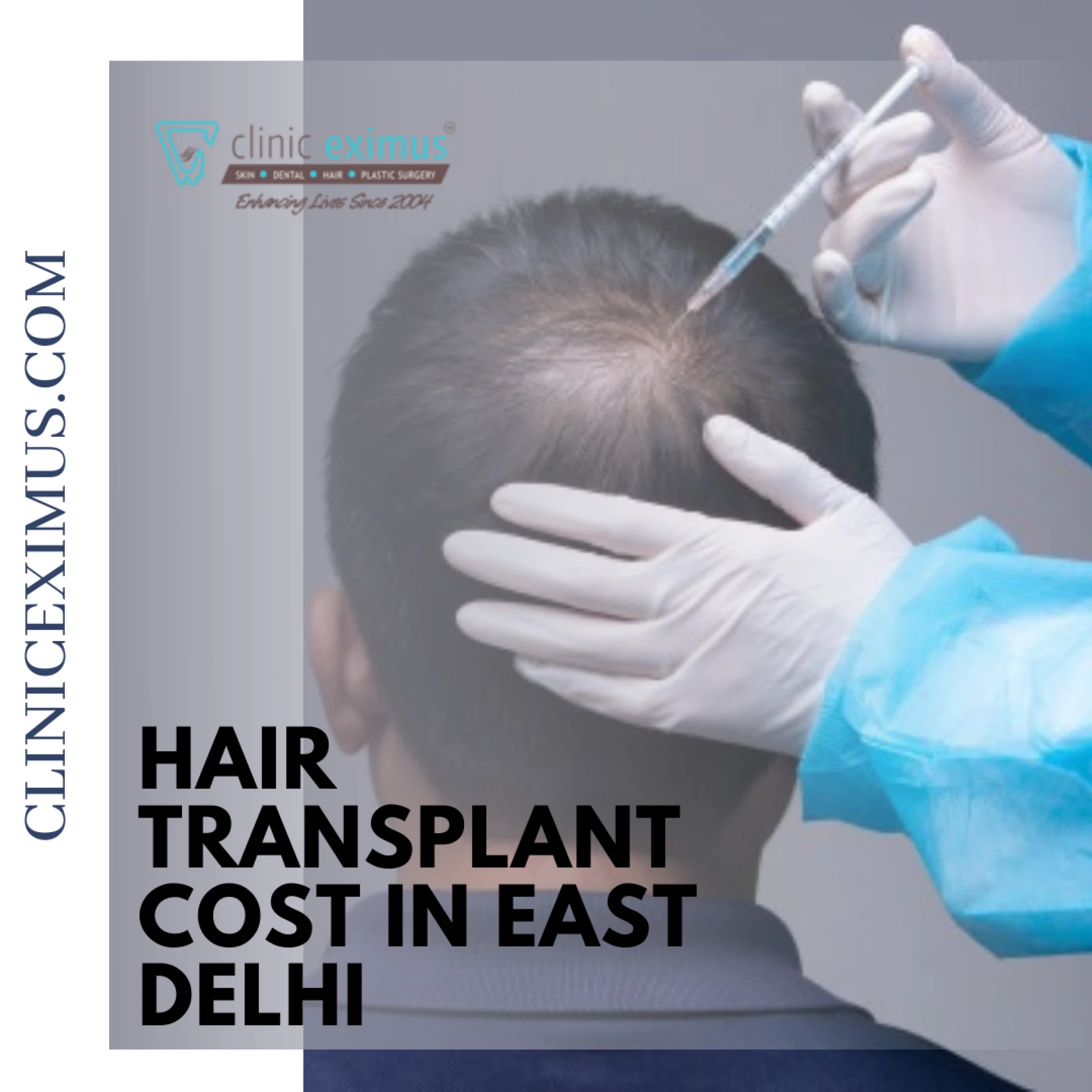 Professionalism at Its Best Hair Transplant Cost in East Delhi