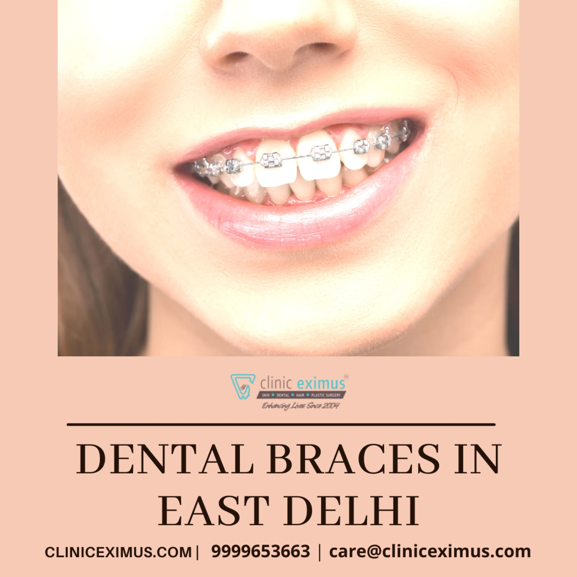 Orthodontists Suggest Patients - Dental Braces in East Delhi