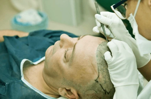 Hair transplant in Delhi