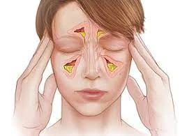 اعراض صداع الجيوب الانفية