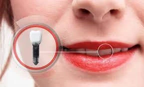Cosmetic Implants Market Size 2028: Demand, Data, Forecast and Analysis