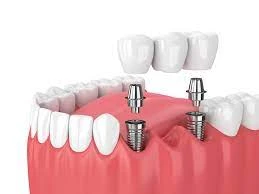 How big is the Cosmetic Implants Market ? with full Detail |