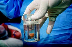 Prostatic Arterial Embolization Market Analysis &amp; Opportunity Outlook 2027