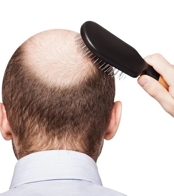 The Bald is Beautiful... Except When It's Not: Learn Hair Replacement Techniques