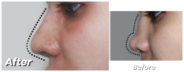 Rhinoplasty in Lahore: Transform Your Appearance with Cosmeticoplasty