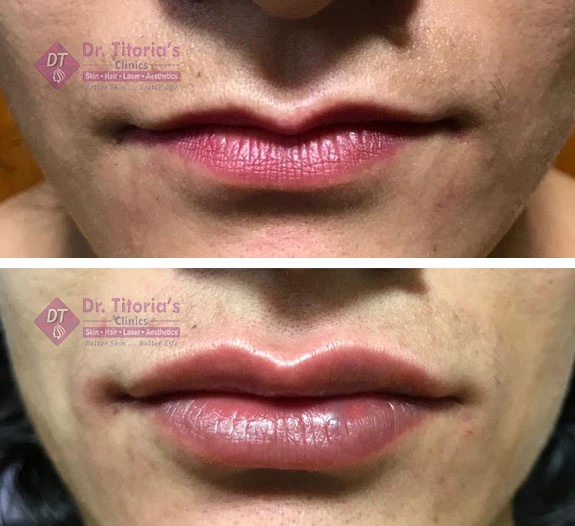 Make Your Lips Plumper and Fuller at Dr. Titoria’s