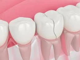 Go for Dental Implants if you Find These 3 Signs