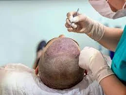 Best Hair Transplant Surgeon in Aurangabad