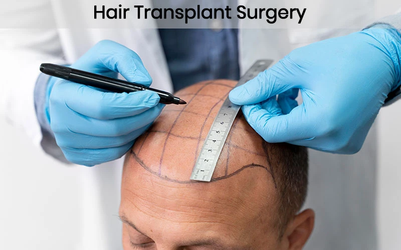 Hair Transplant Surgery in Aurangabad