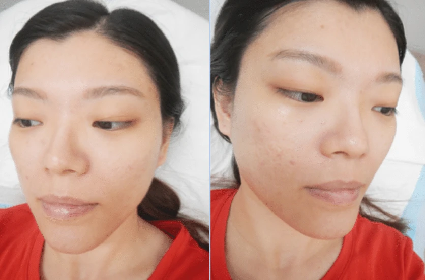 The Essential Information You Need About Acne Treatments In Singapore