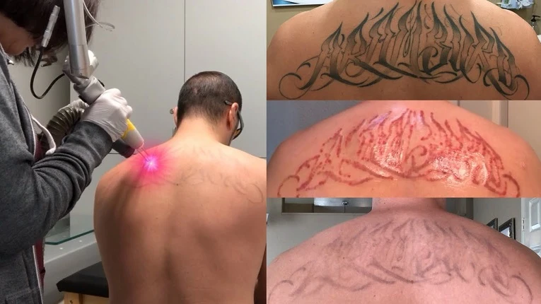 Does Laser Tattoo Removal Really Work On You?