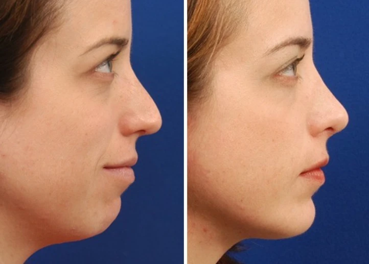 Chin Augmentation: Everything You Need to Know