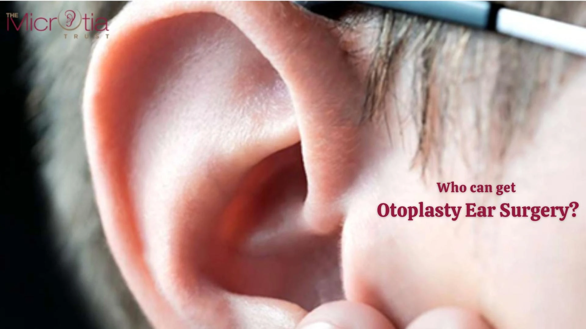 Who can get Otoplasty Ear Surgery?
