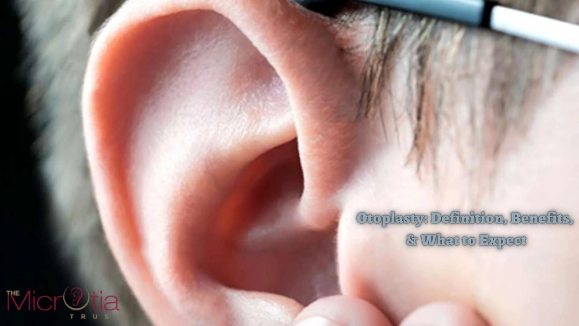 Otoplasty: Definition, Benefits, &amp; What to Except