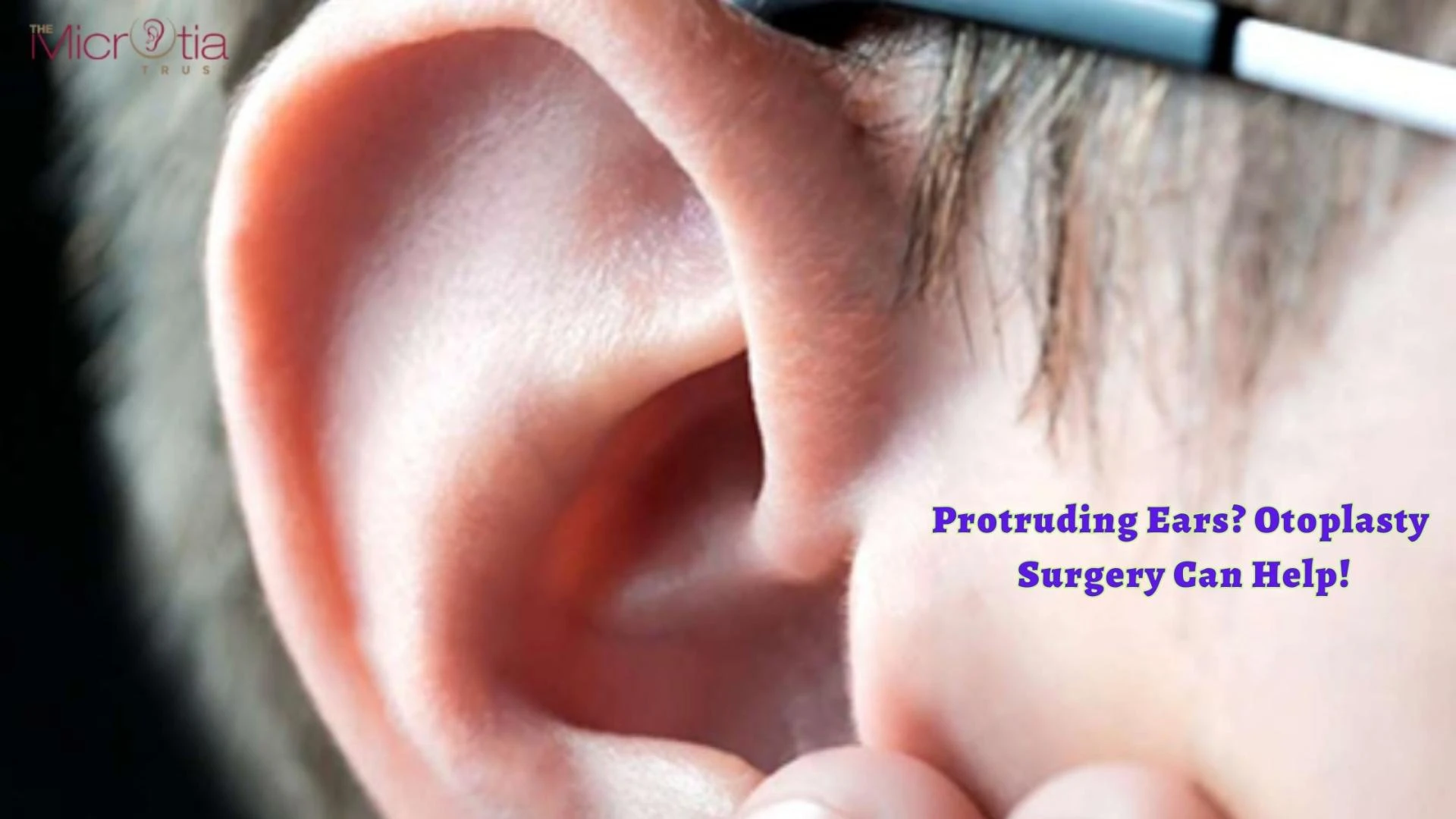 Protruding Ears? Otoplasty Surgery Can Help!
