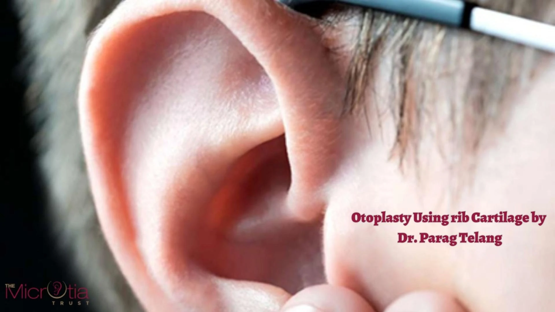 Otoplasty Using rib Cartilage by Dr. Parag Telang