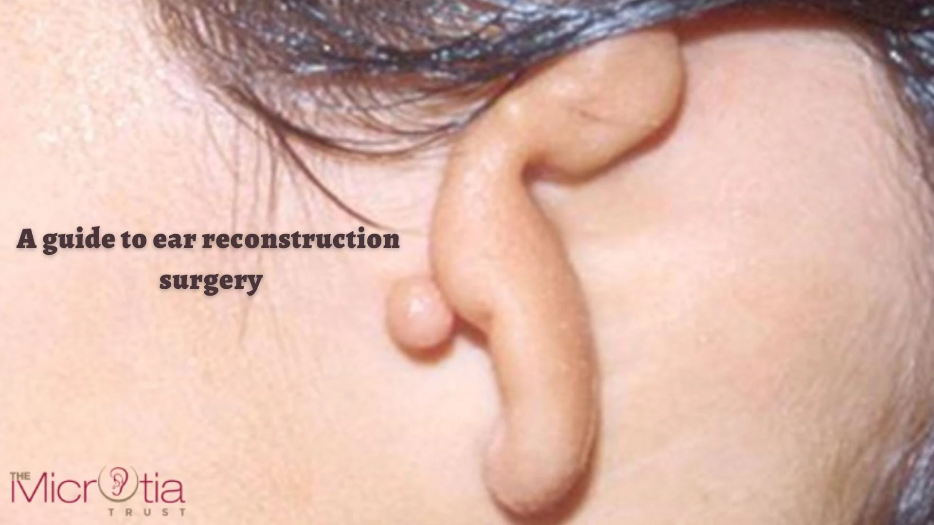 A guide to ear reconstruction surgery