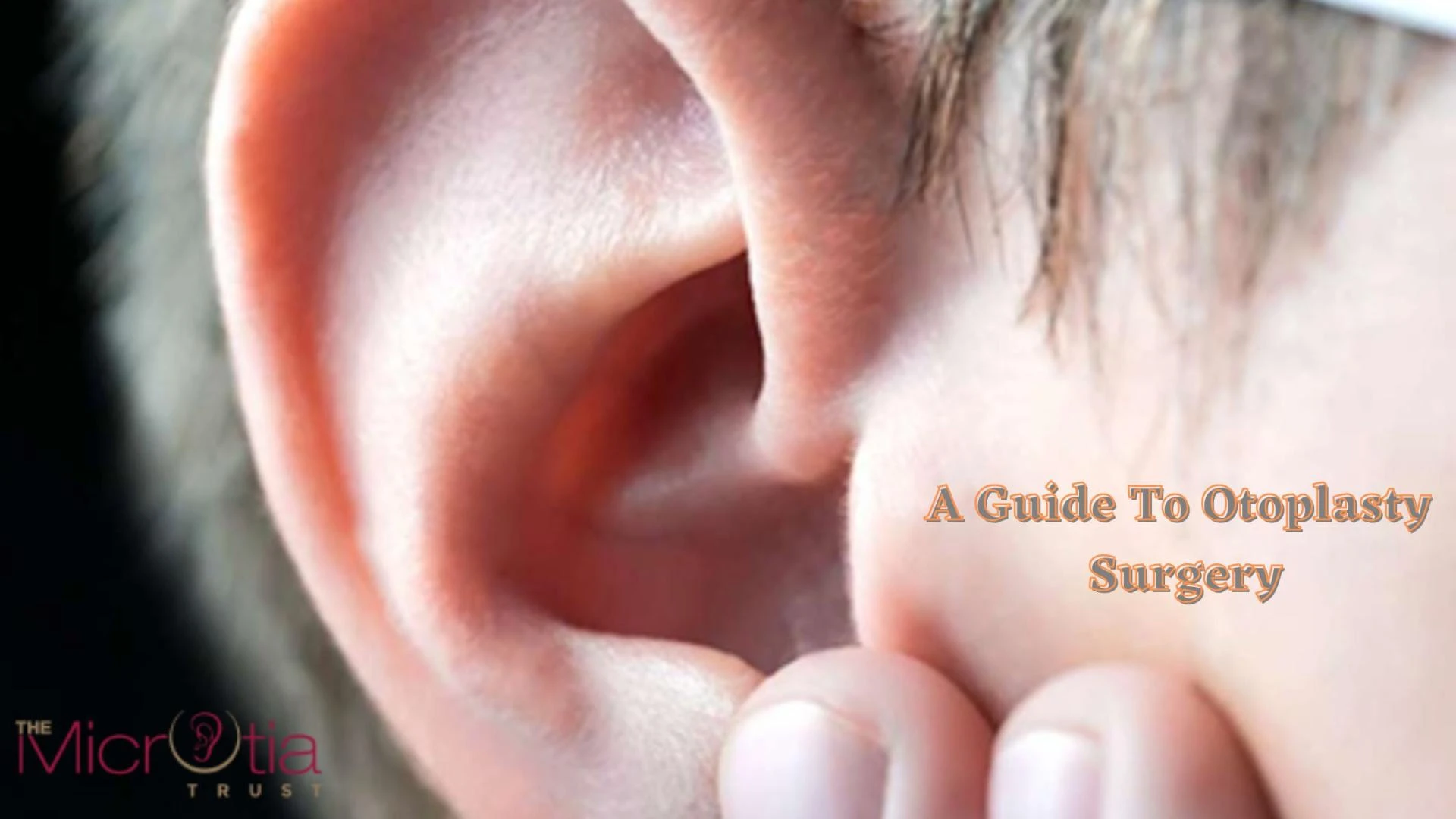 A Guide To Otoplasty Surgery