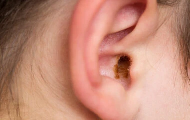 Online Conductive Hearing Loss