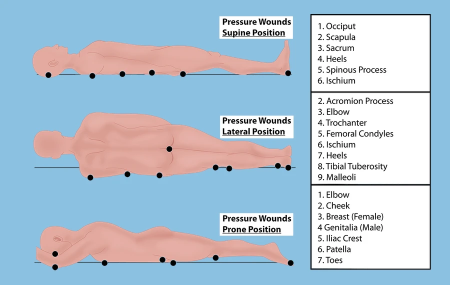 Understanding Diabetic Leg Ulcers: Causes, Treatment, and Prevention!