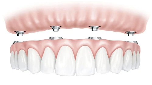 Full-Arch Restoration with Minimal Implants With All-on-4 Dental Implants