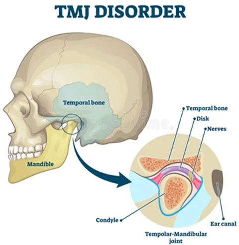 What Is TMJ &amp; How Can a Dentist Deal With This in Doral, FL