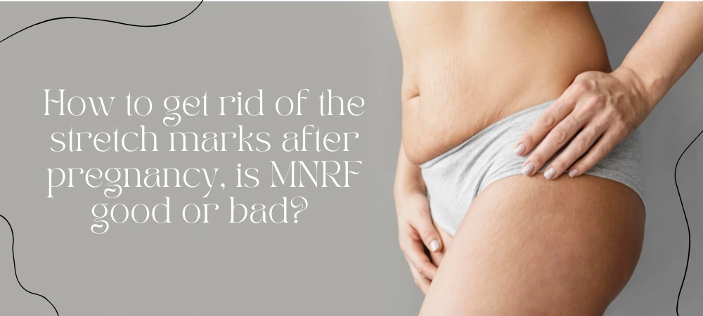 How to get rid of the stretch marks after pregnancy, is MNRF good or bad?