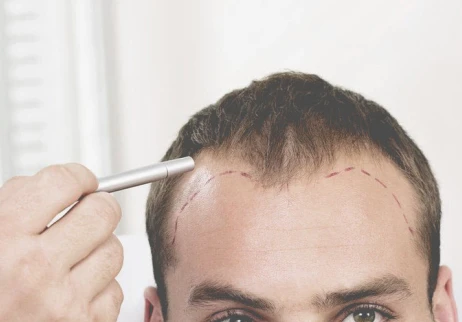 The Role of Genetics in Determining the Success of the Best Hair Transplant