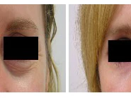 Common Myths About Eyelid Surgery Clinics Debunked
