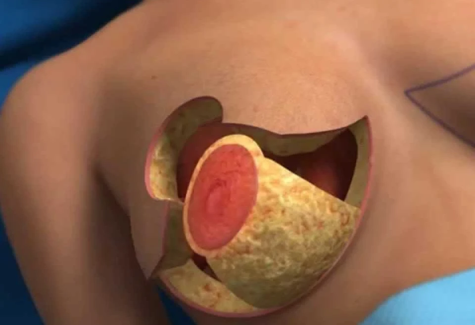 Choosing Between Local and Out-of-State Breast Reduction Clinics