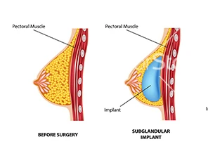The Impact of Clinic Location on Breast Augmentation Costs