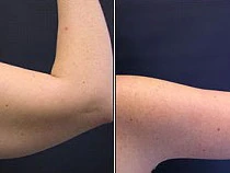 Arm Lift Cost Breakdown: Surgery, Anesthesia, and Facility Fees