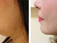 The Premier Chin Augmentation Clinics for Natural-Looking Results