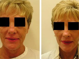 Enhancing Your Natural Beauty: The Role of Facelifts in Self-Confidence