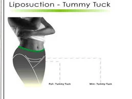 Understanding the Healing Process: Tummy Tuck in Oman