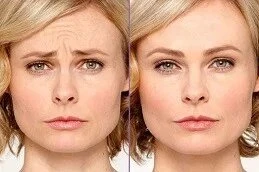 In Pursuit of Perfection: How Botox Boosts Self-Confidence