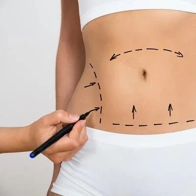 The Evolution of Tummy Tucks: Advancements in Abdominoplasty Techniques