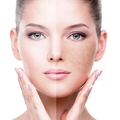 Pigmentation 101: Understanding and Conquering Treatment Challenges