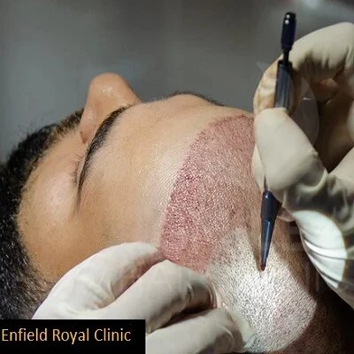 The Healing Process: What to Expect After Your FUE Hair Transplant