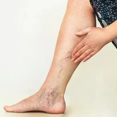 Common Myths About Sclerotherapy Debunked