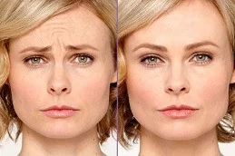 Ageless Beauty: Exploring the World of Botox Treatments
