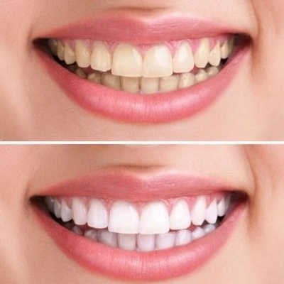 Teeth Whitening Myths Debunked: Separating Fact from Fiction