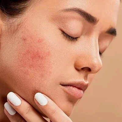 The Role of Diet in Acne Management